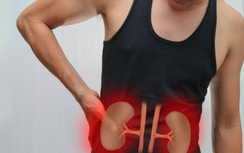 Không chủ quan trị sỏi thận bằng thuốc Nam